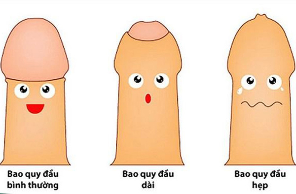 Bao quy đầu bị dài hoặc hẹp có thể gây mùi hôi