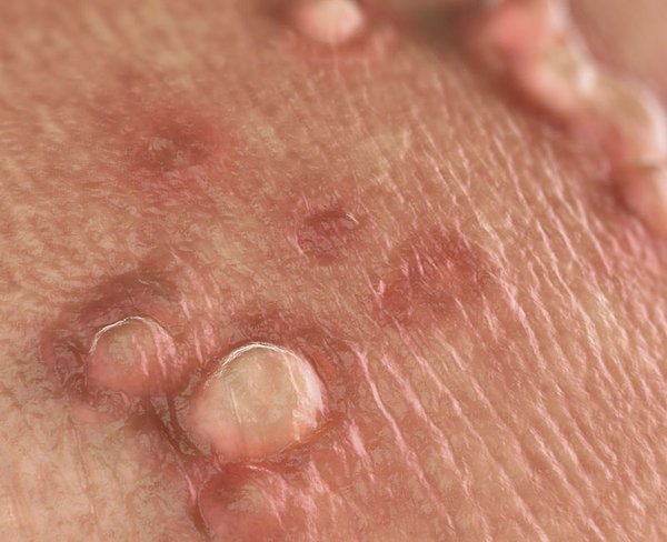 Bệnh mụn cóc sinh dục