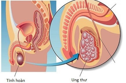 Tỉ lệ người mắc ung thư tinh hoàn không cao nhưng chúng lại thường xảy ra với độ tuổi từ 15 đến 35 tuổi