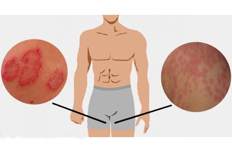 Một trong những dấu hiệu bị nấm bẹn đó là ngứa, xuất hiện các mảng đỏ, mụn nước mọc li ti