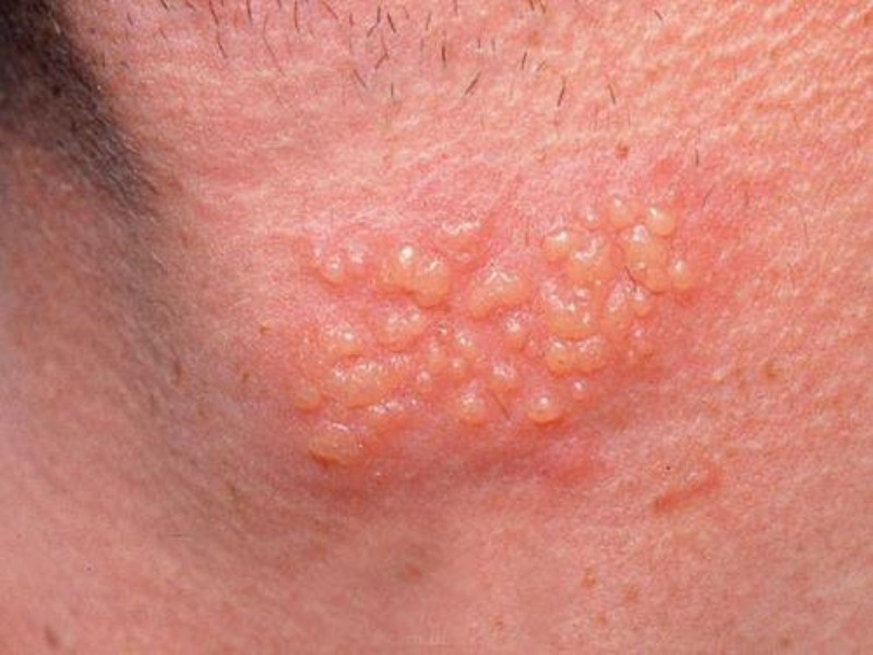 Sùi mào gà rất dễ gây mẩn đỏ